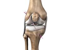 ACL Reconstruction Patellar Tendon