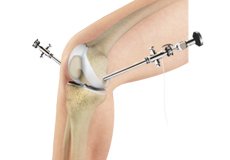 Knee Arthroscopy