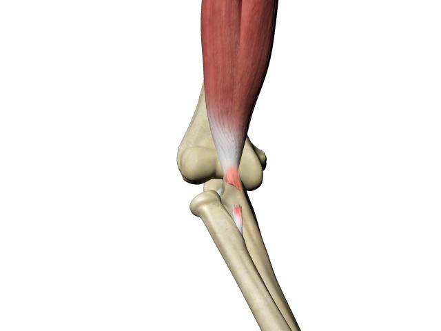 Distal Biceps Tear