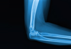 Pilon (Distal Tibial Articular) Fracture