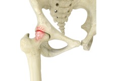 Femoro Acetabular Impingement FAI