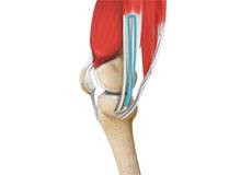 ACL Reconstruction Procedure – Hamstring Tendon