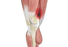 Illiotbial Band Syndrome