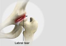 Labral Tear