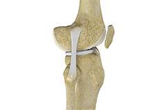 Lateral Collateral Ligament (LCL)