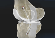 Posterior Cruciate Ligament Anatomy