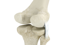 Posterolateral or Posteriormedial Corner Injury