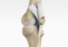 Patella or Quad Tendon Rupture