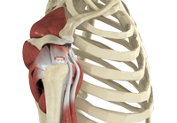 Rotator Cuff Tear