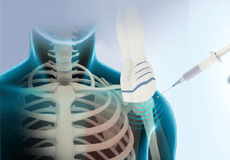 Ultrasound Guided Shoulder Injections